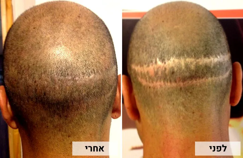 דוגמא לצלקת בקרקפת